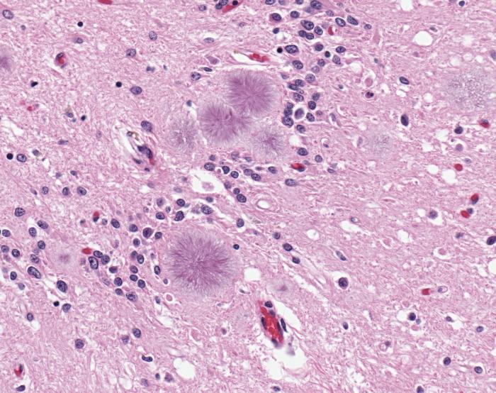 The presence of amyloid plaques in a brain section. Image courtesy of https://commons.wikimedia.org/wiki/File:Variant_Creutzfeldt-Jakob_disease_%28vCJD%29,_typical_amyloid_plaques,_H%26E.jpg
